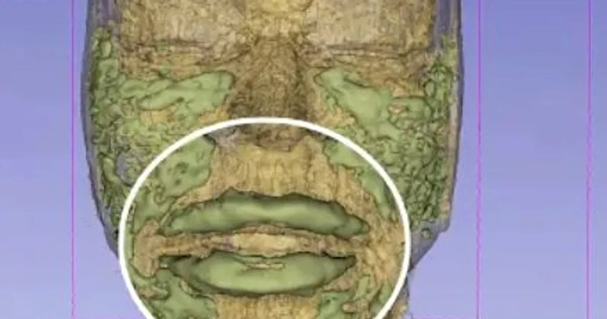 гіалуронові філери – детальна інформація