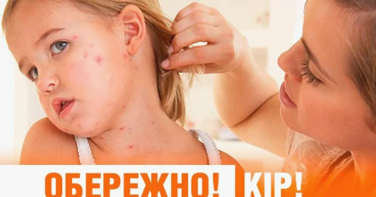 випадки кору на Закарпатті